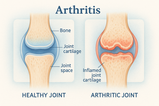 Arthrose